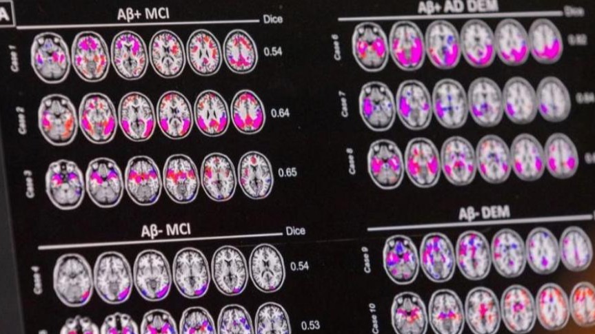 数十万元阿尔茨海默病疗法纳入首版商保创新药目录,离进医保还远吗 第1张 数十万元阿尔茨海默病疗法纳入首版商保创新药目录,离进医保还远吗 第1张